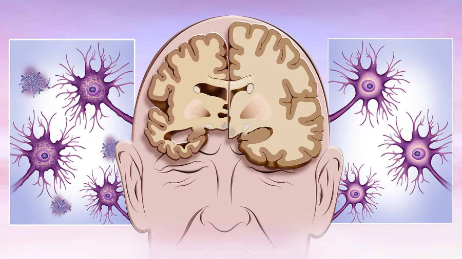 Alzheimer's Disease Prediction Using Deep Learning