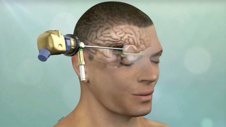 Minimally Invasive Brain Surgery: High Precision, Quick Recovery