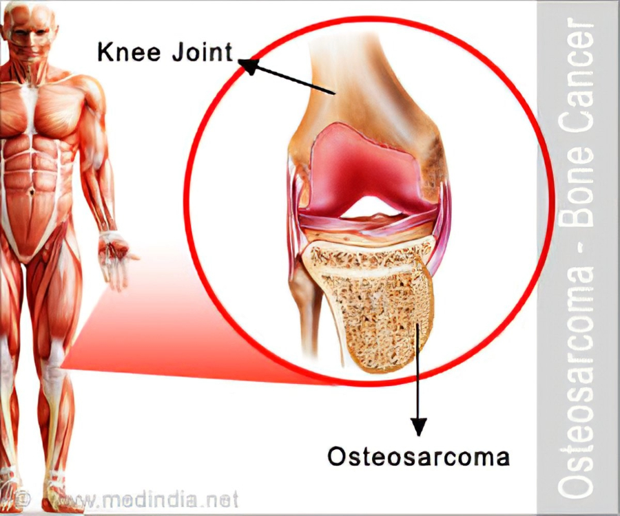 Osteosarcoma
